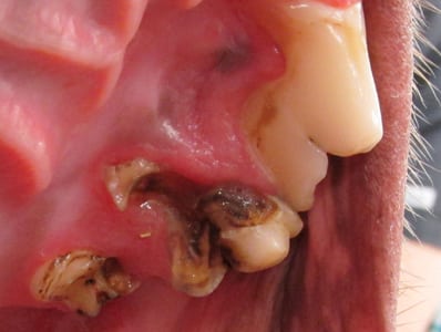 Severe Cavity on a Dog's Tooth